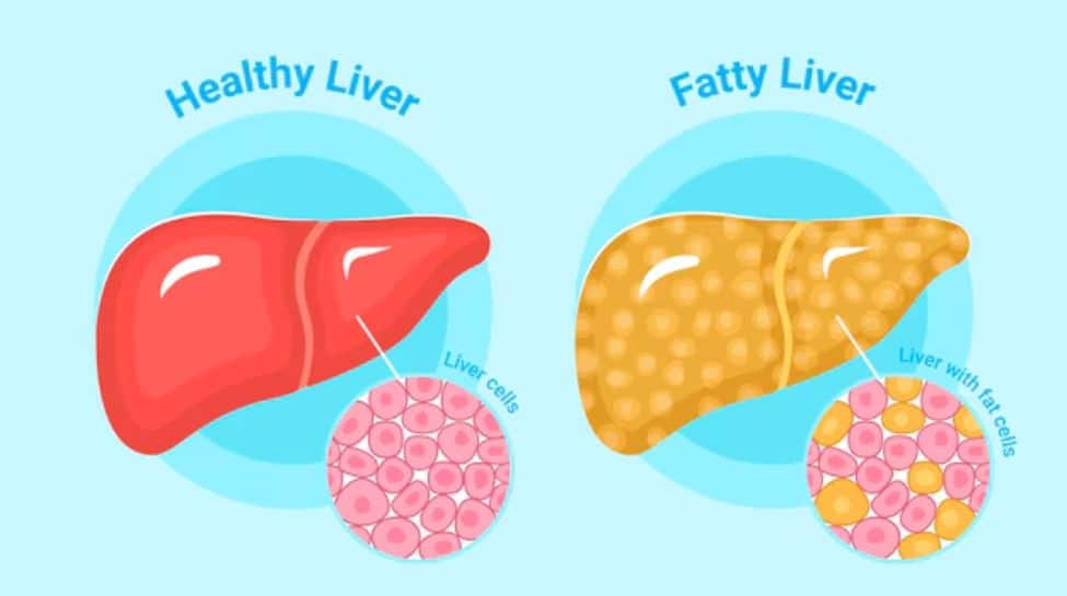 unlocking-health:-how-quality-sleep-can-shield-against-cirrhosis-in-non-alcoholic-fatty-liver-disease