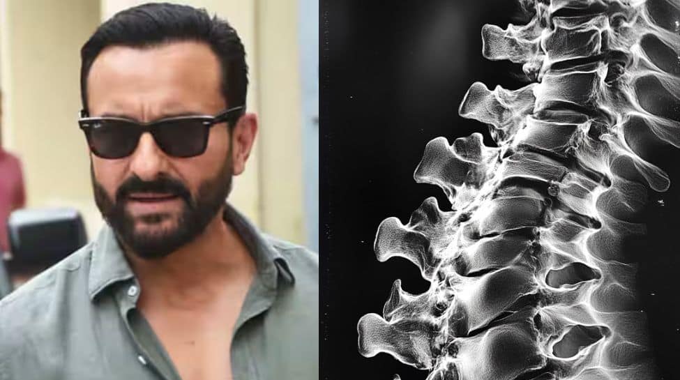 saif-ali-khan-faces-serious-health-scare:-doctor-reveals-risks-of-thoracic-spinal-cord-injury-and-fluid-leak